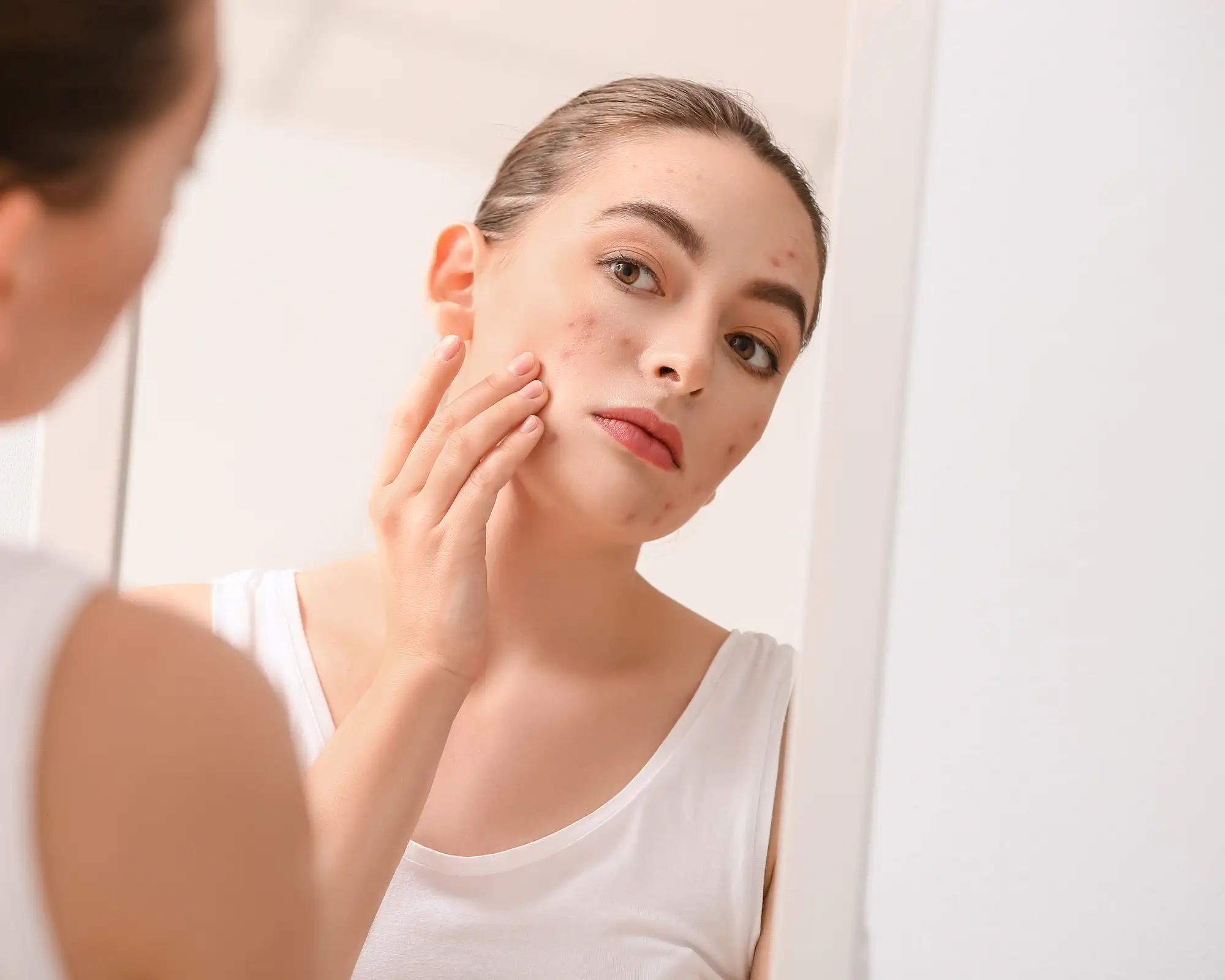 Ακμή και ευαισθησία μαζί; 1 Λύση με 3 βήματα